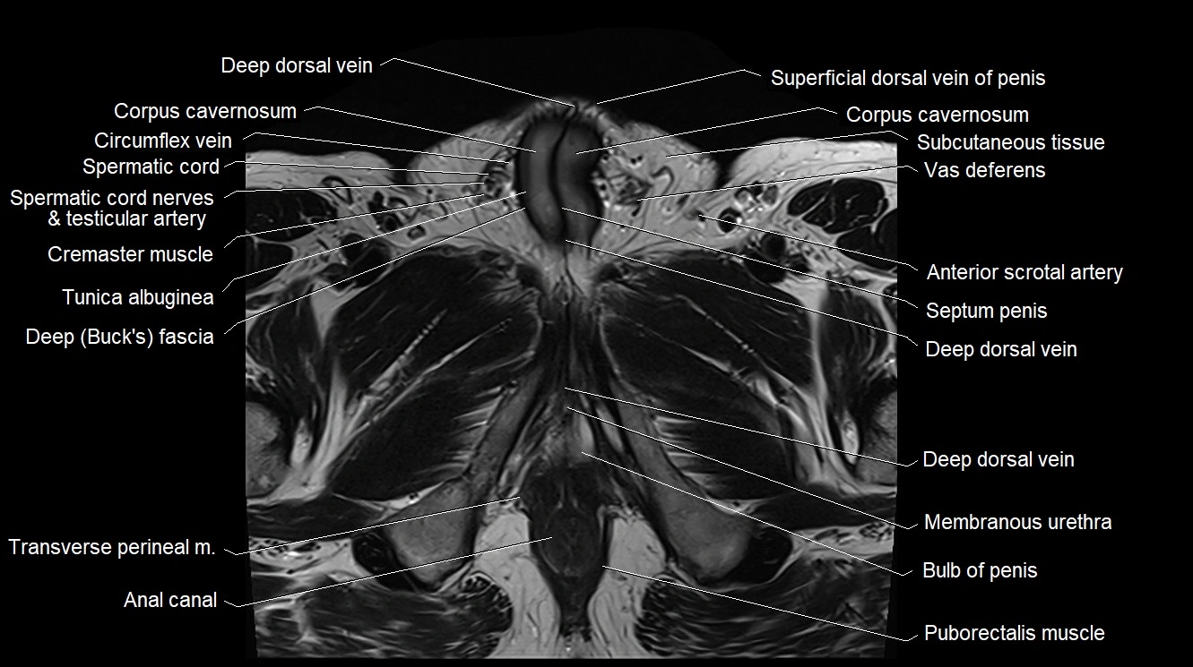 MRI 3T scrotum and penis axial cross sectional anatomy image 16.webp